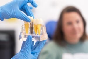 dental implant model