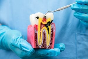 root canal model