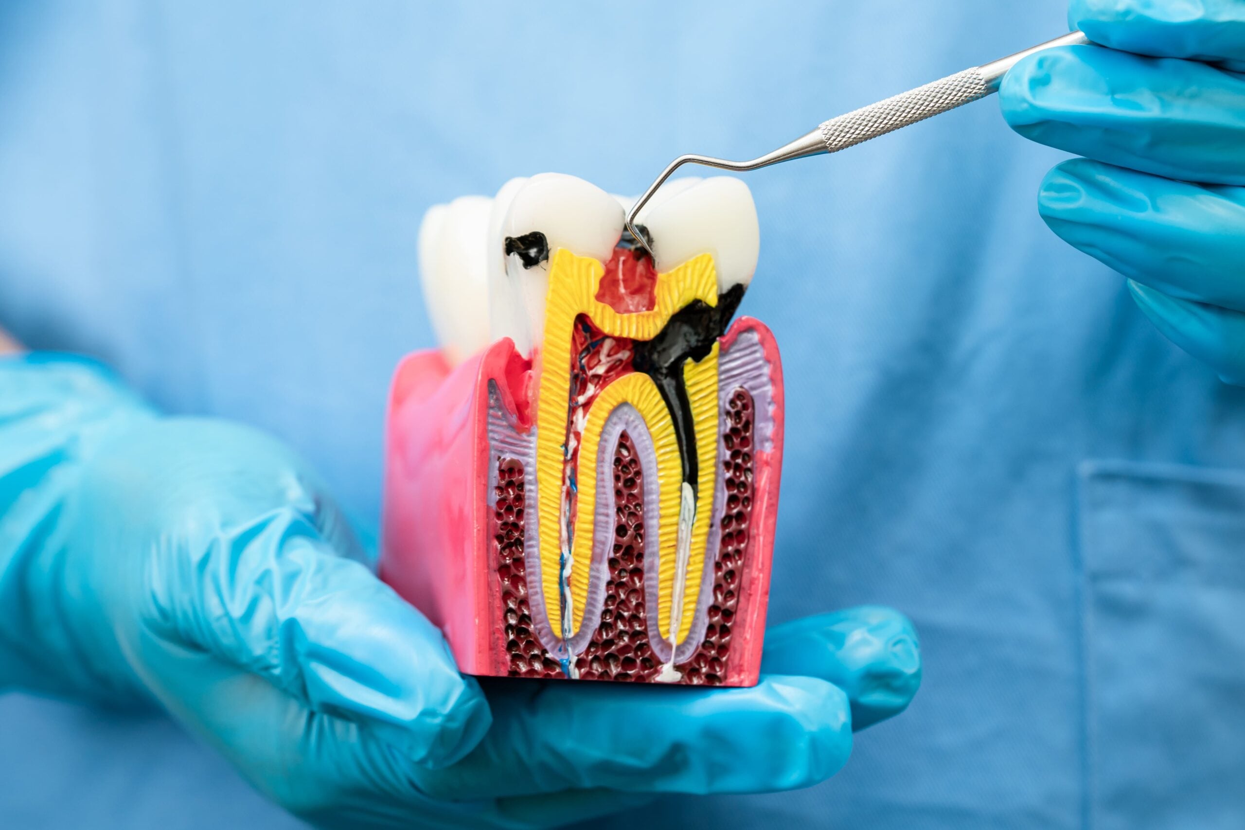 root canal model